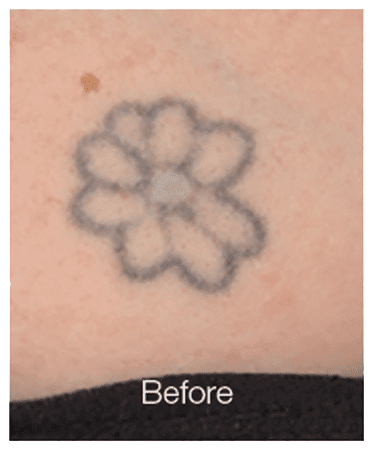 Tattoo Removal In Tucson | Perfection Plastic Surgery And Skin Care