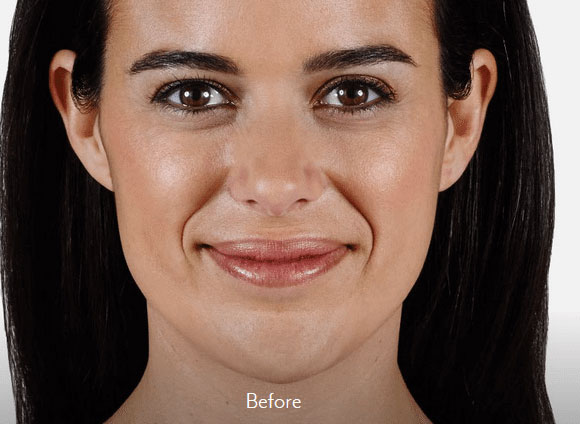Juvederm Vollure-before