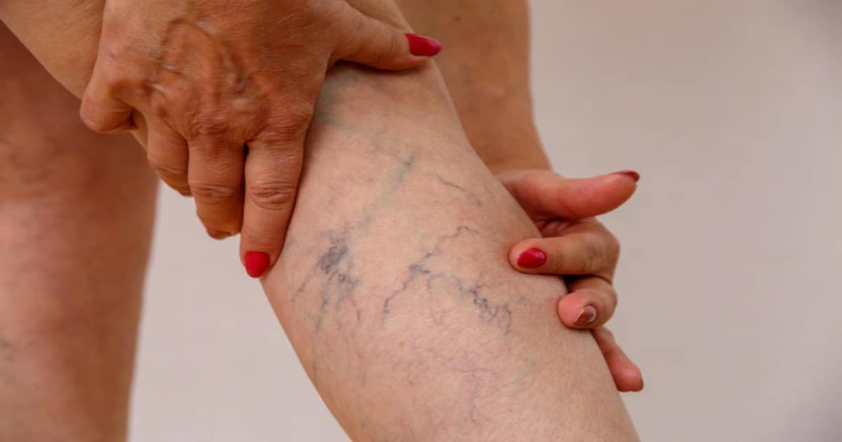 The Many Advantages of Laser Vein Therapy: What You Need to Know