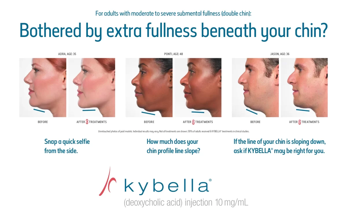 KYBELLA A New Non surgical Treatment for Reducing Double Chins